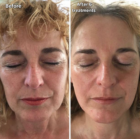Skin Firmness