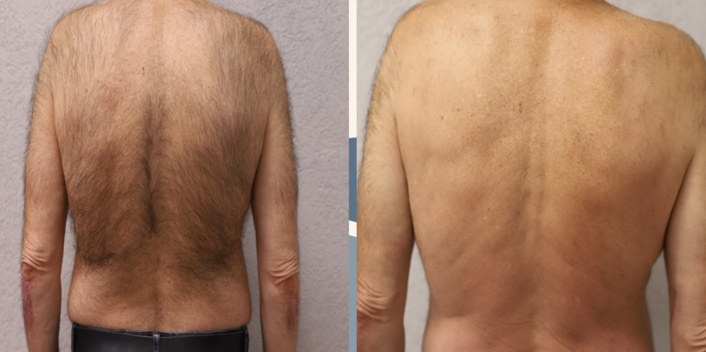 After Alpha Diode laser hair removal at Gustil Aesthetics Amsterdam