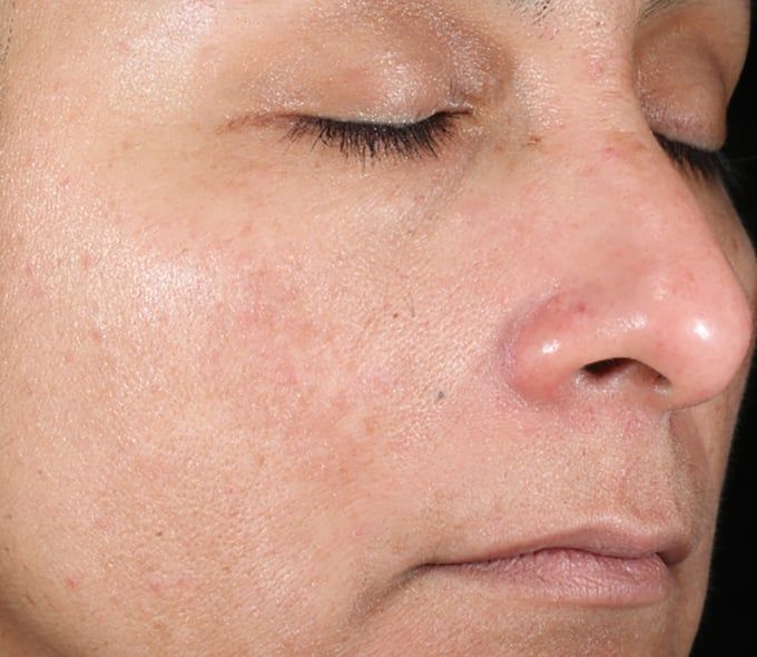 After iS Clinical Active Peel System