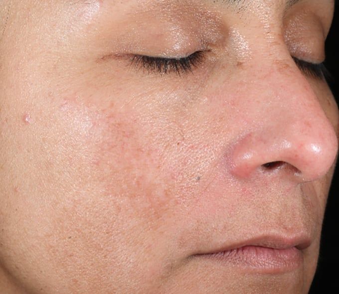 Before iS Clinical Active Peel System