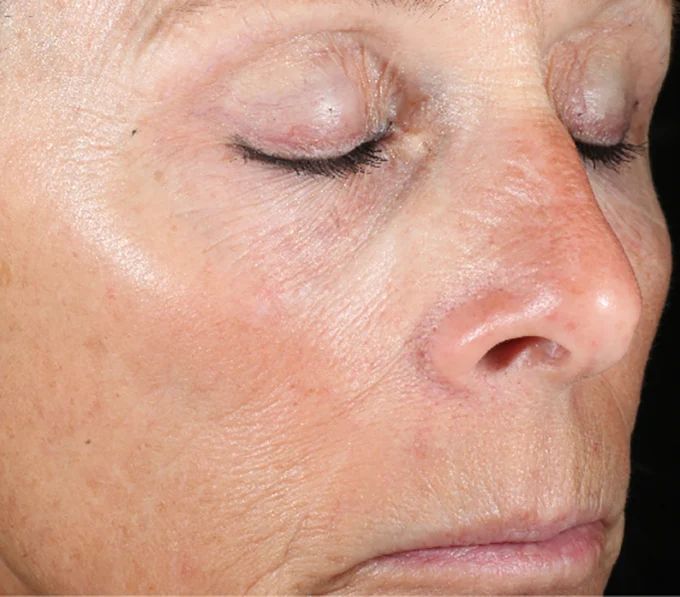After iS Clinical Active Peel System