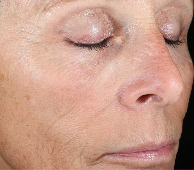 Before iS Clinical Active Peel System