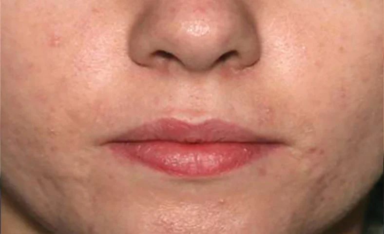 Acne After Active Serum