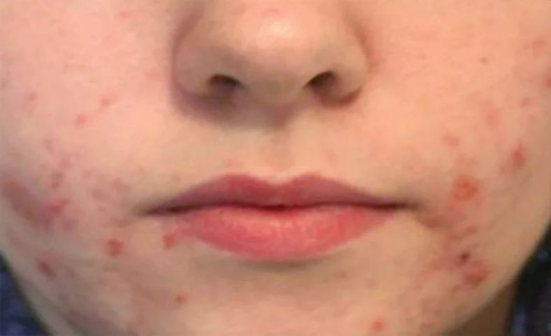 Acne Before