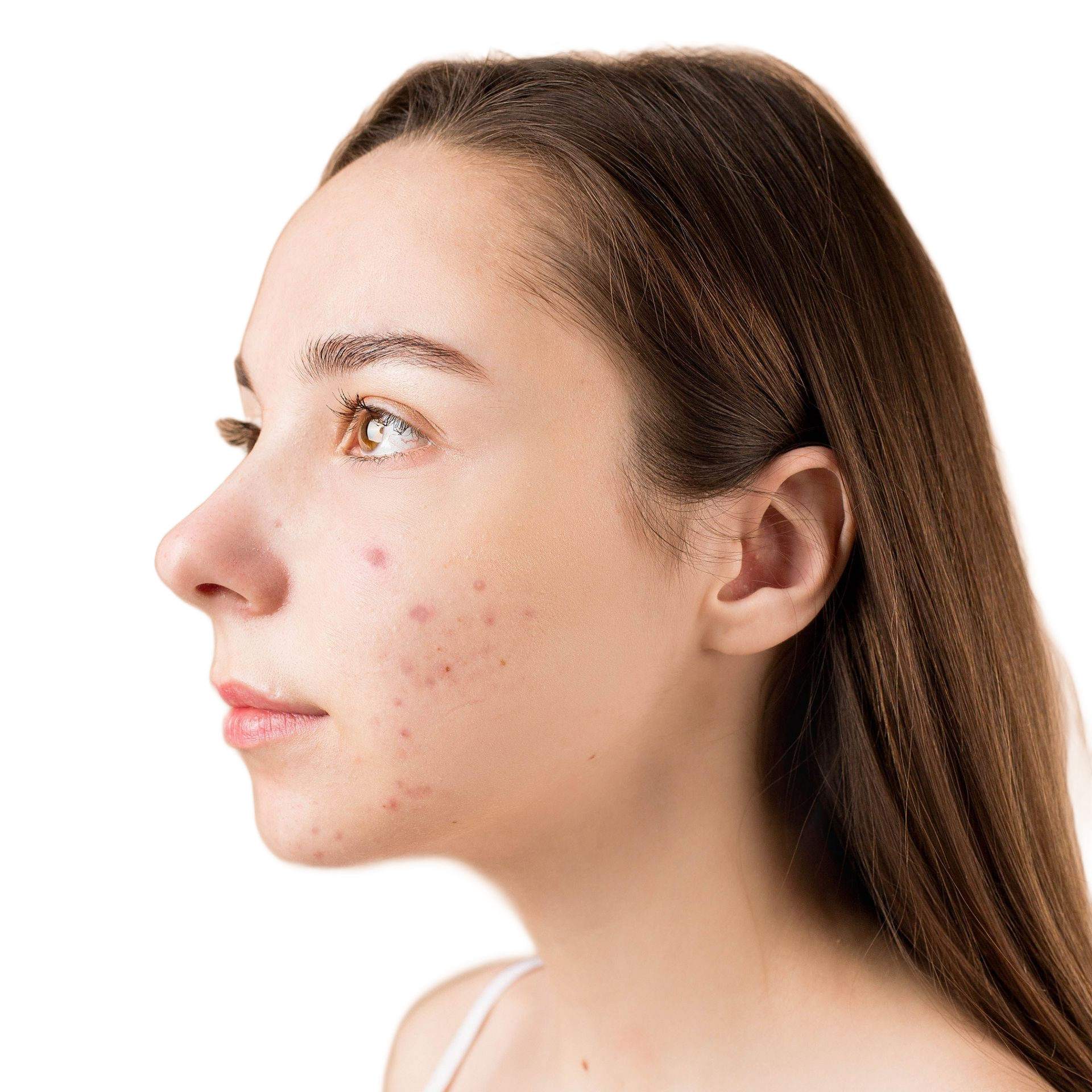 Skincare for acne and blemish prone skin