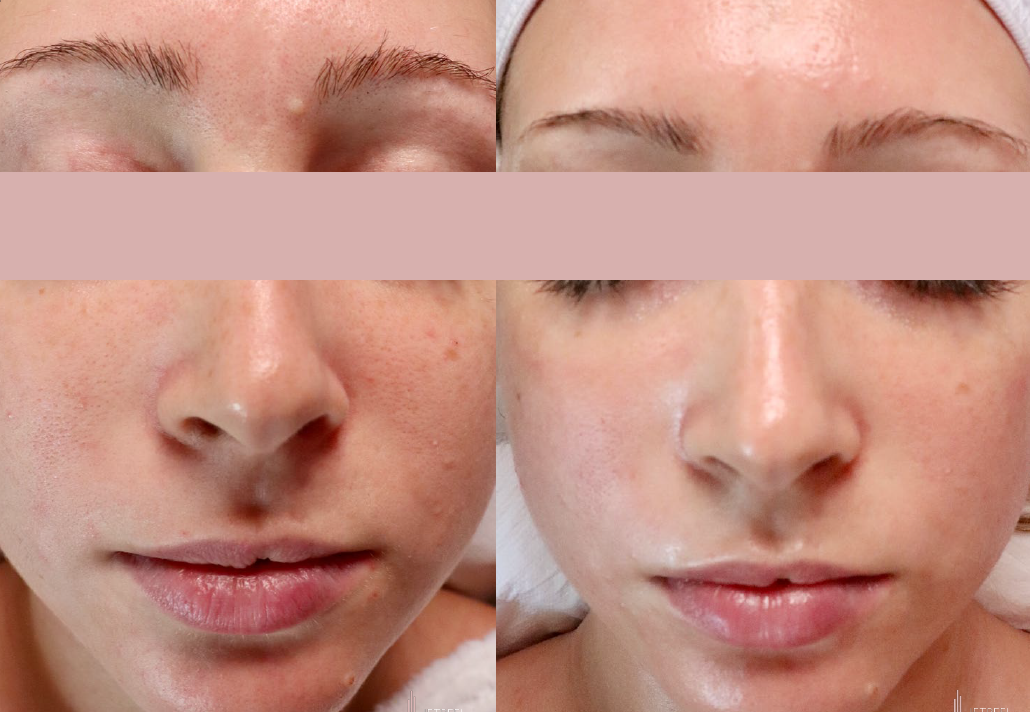 BeforeafterJetpeel2
