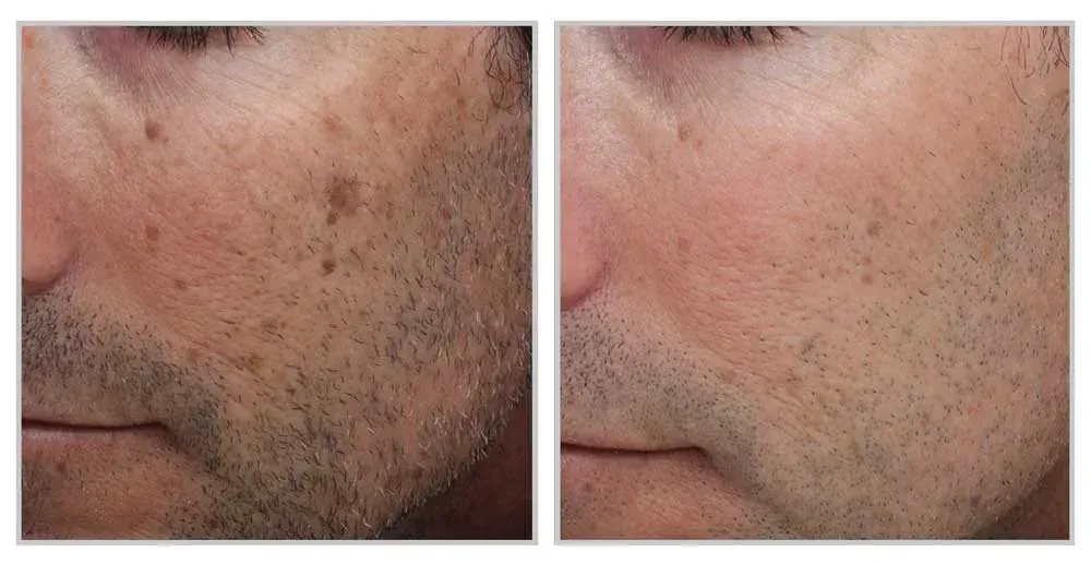 PhotoBiodynamic Therapy Acne Neck