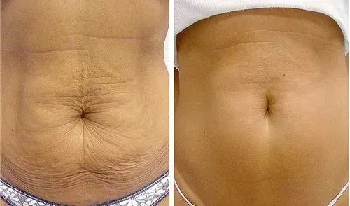 Before and after post pregnancy skin treatment case 2