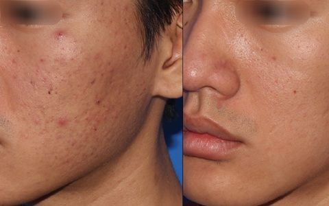 Acne-prone skin before and after treatment