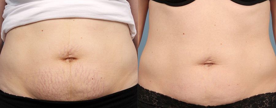 Postpartum Skin Recovery
