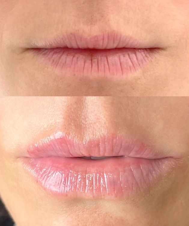 PhotoBiodynamic Therapy Acne Neck