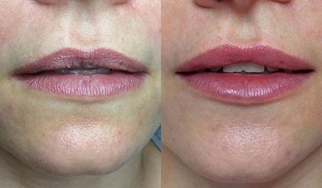 PhotoBiodynamic Therapy Acne Neck