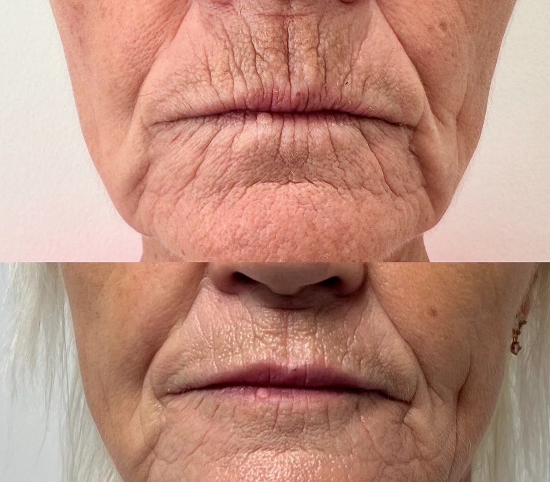 PhotoBiodynamic Therapy Acne Neck