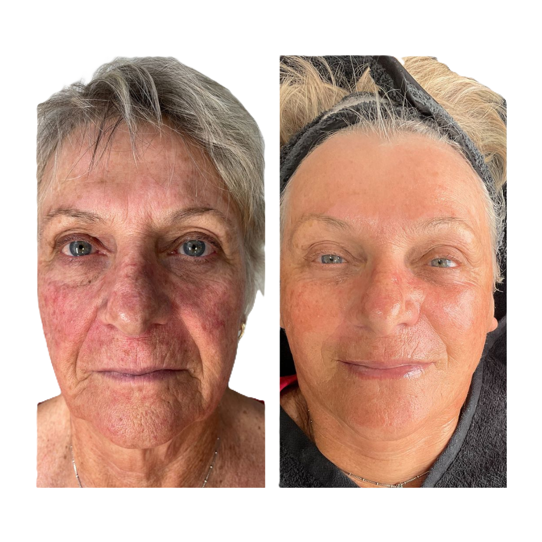Pigmentation & Texture