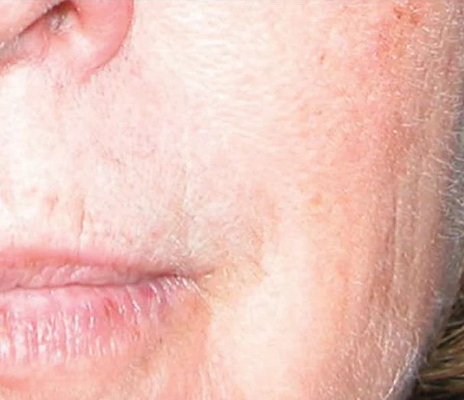 Wrinkles After Active Serum