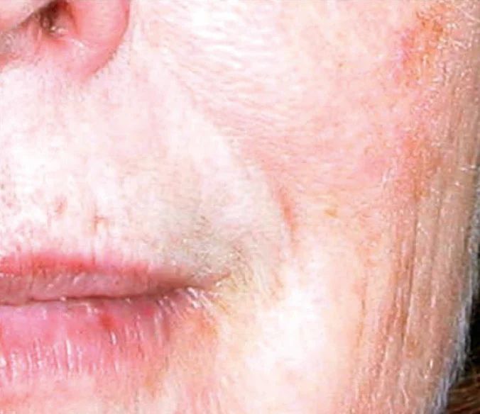 Wrinkles Before Active Serum