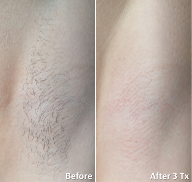 After Alpha Diode laser hair removal at Gustil Aesthetics Amsterdam