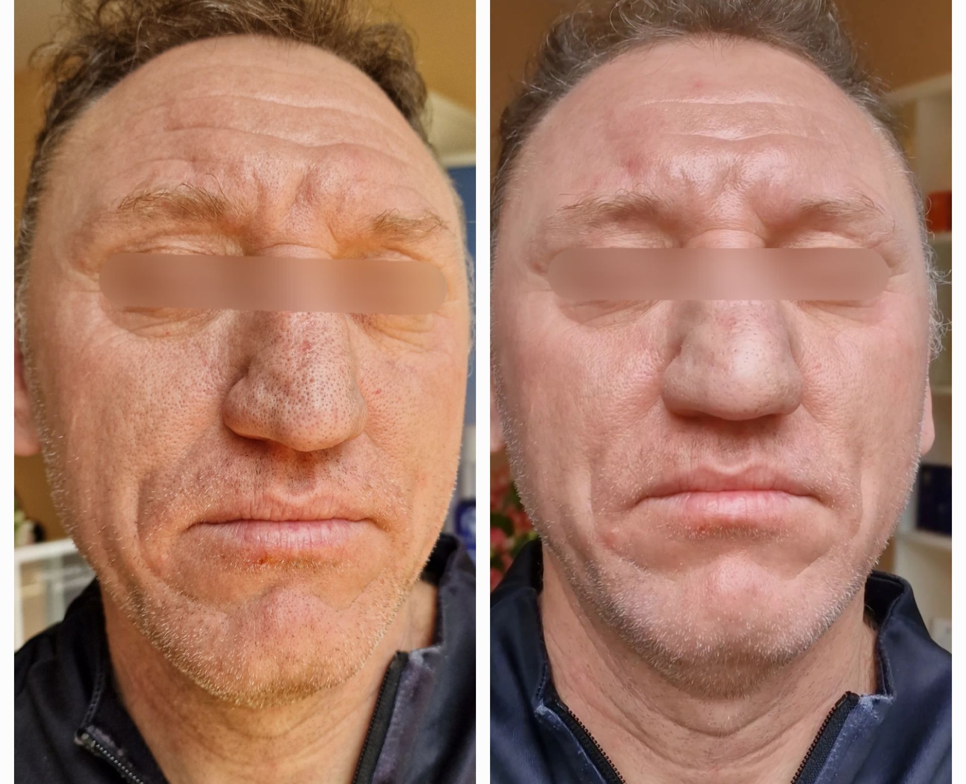 Hydrajet Before and After