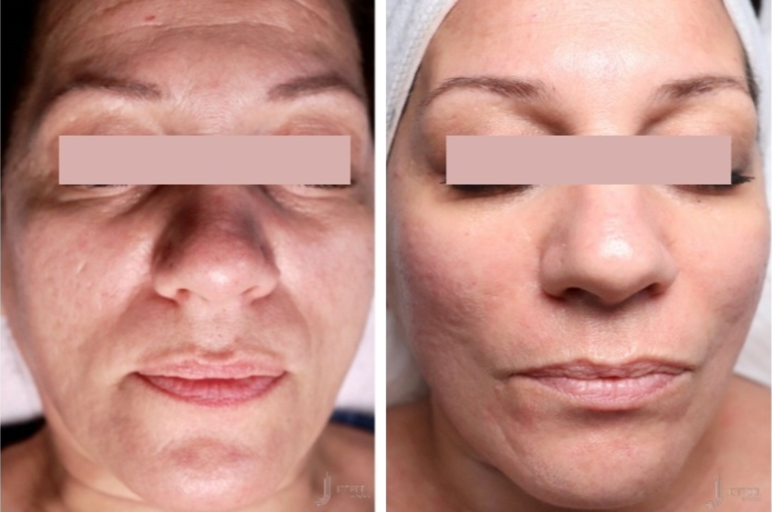 Hydrajet Before and After