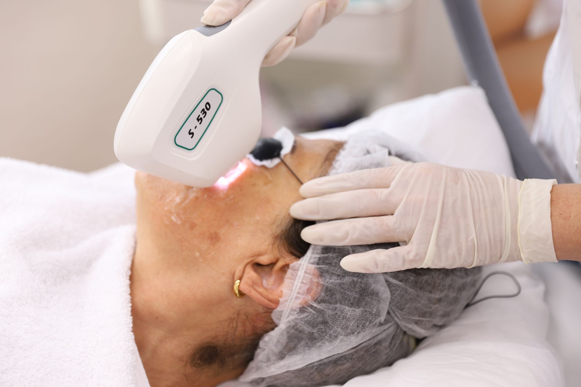 Alpha 3D IPL pigmentation dark spots and hyperpigmentation treatment in Amsterdam
