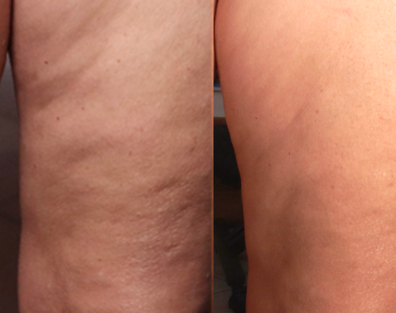 Legs - Before and After