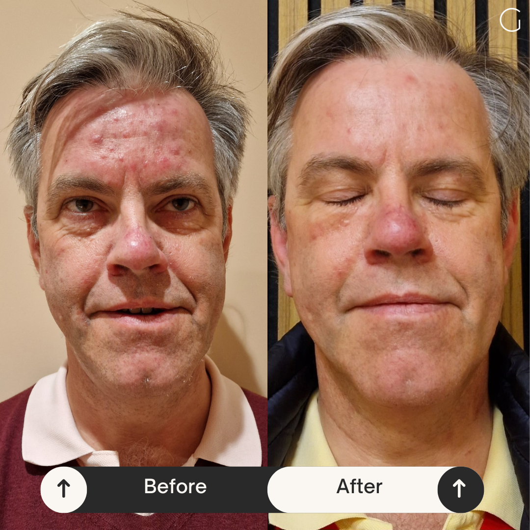Acne result after a premium skin treatment at the clinic