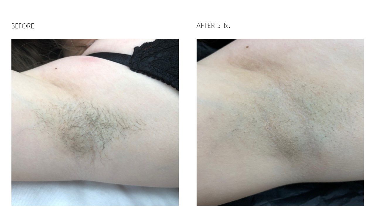 Before Alpha Diode laser hair removal at Gustil Aesthetics Amsterdam