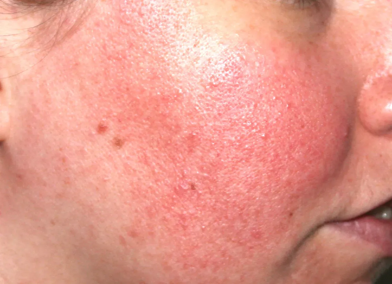 Redness after 1 week of Pro-Heal Serum Advance+
