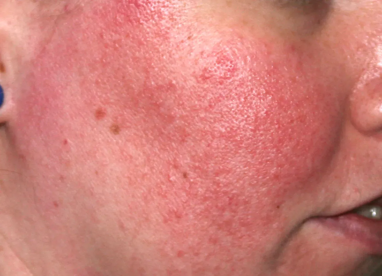 Redness before use pf Pro-heal Serum