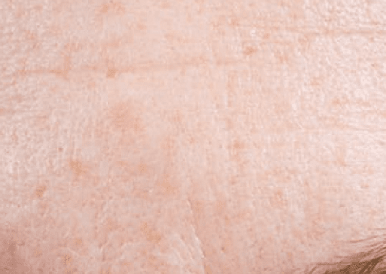 Pigmentation After Active Serum