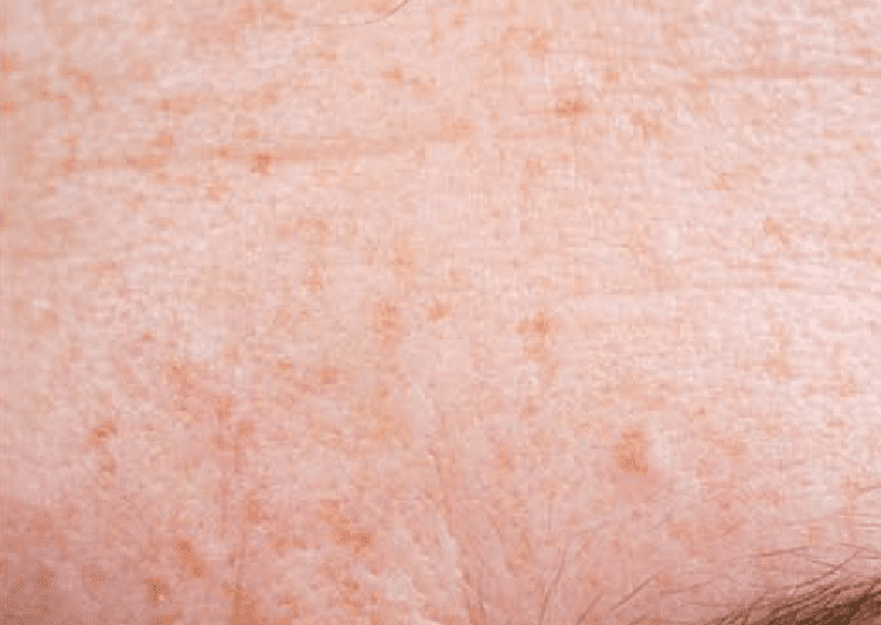 Pigmentation Before Active Serum