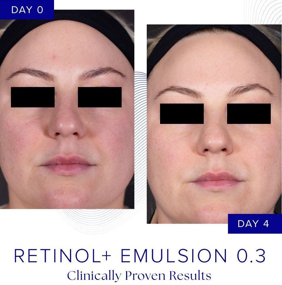 iS Clinical Retinol + Emulsion 0.3 before and after 4 days