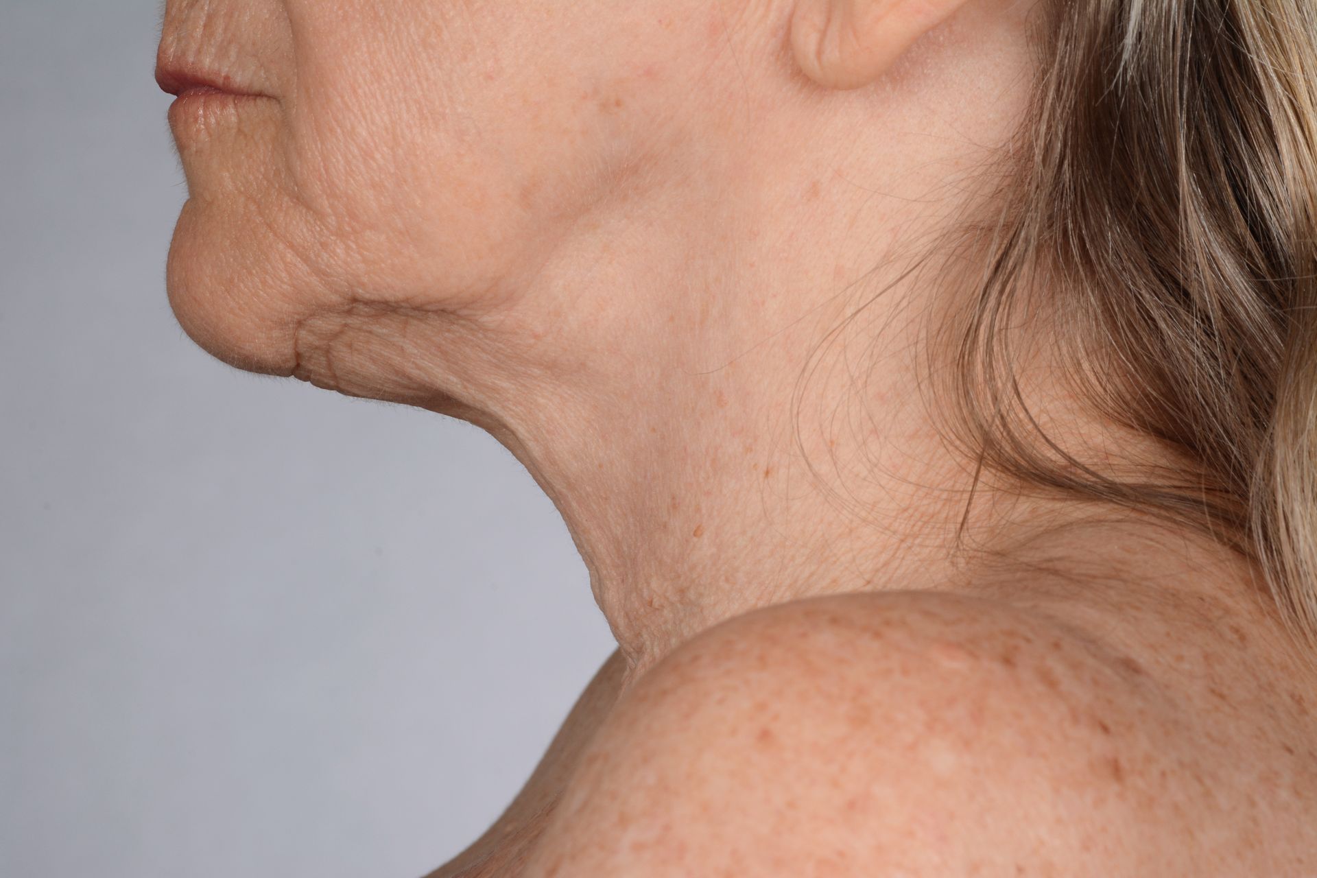 iS Clinical Neckperfect before