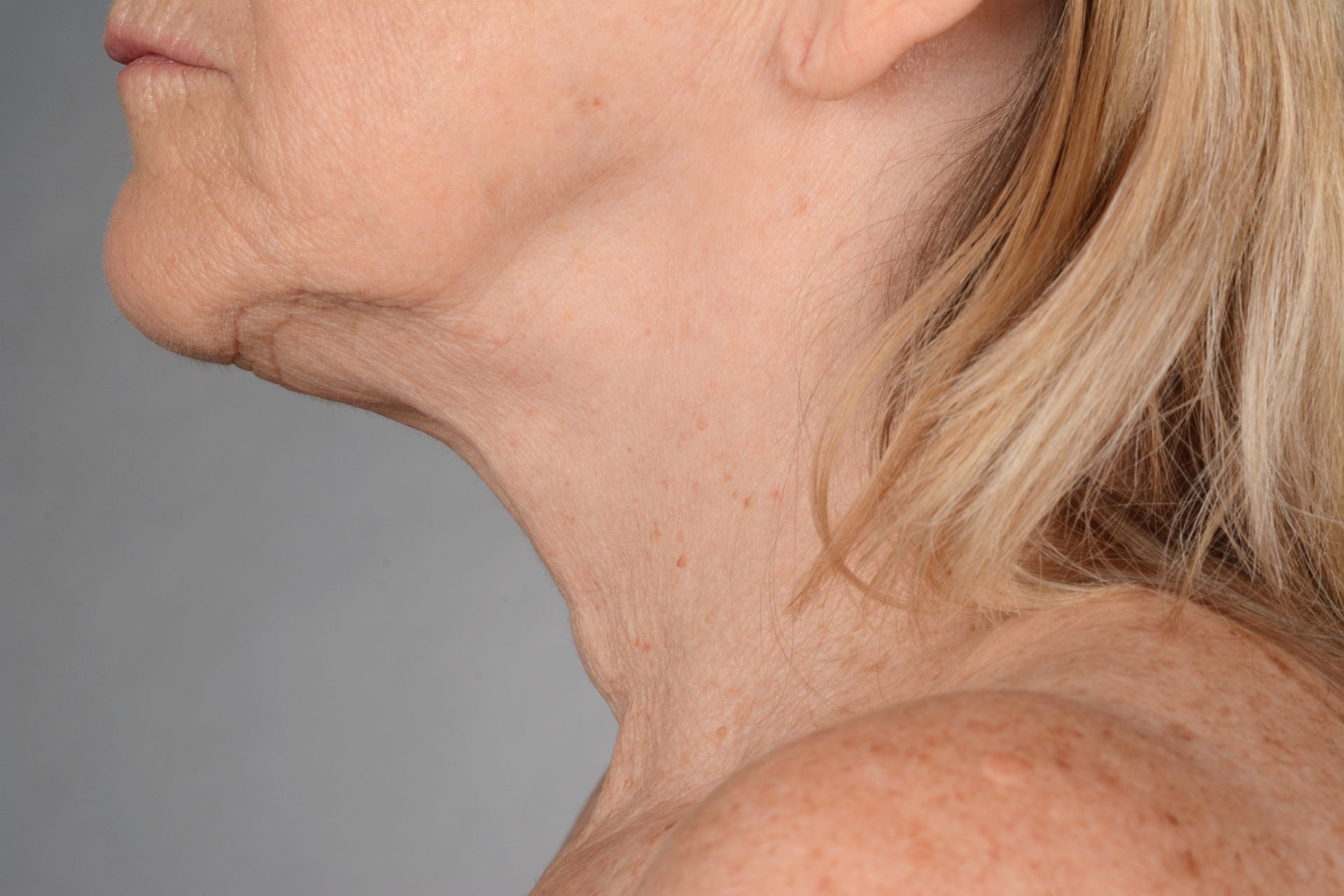 iS Clinical Neckperfect after