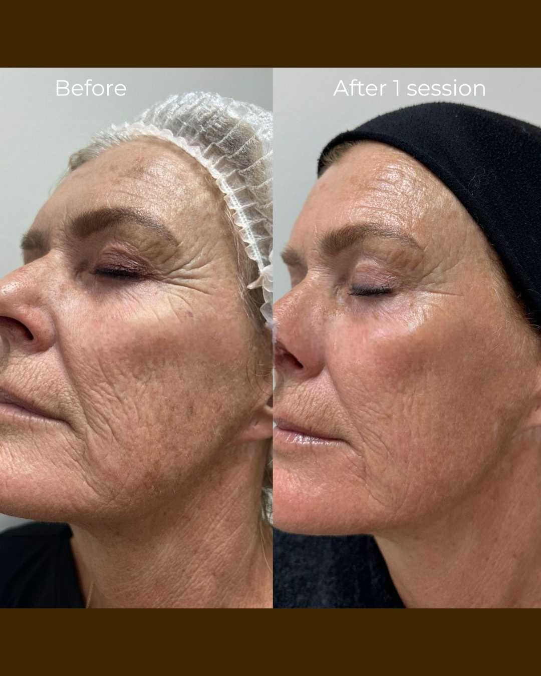 Skin Rejuvenation