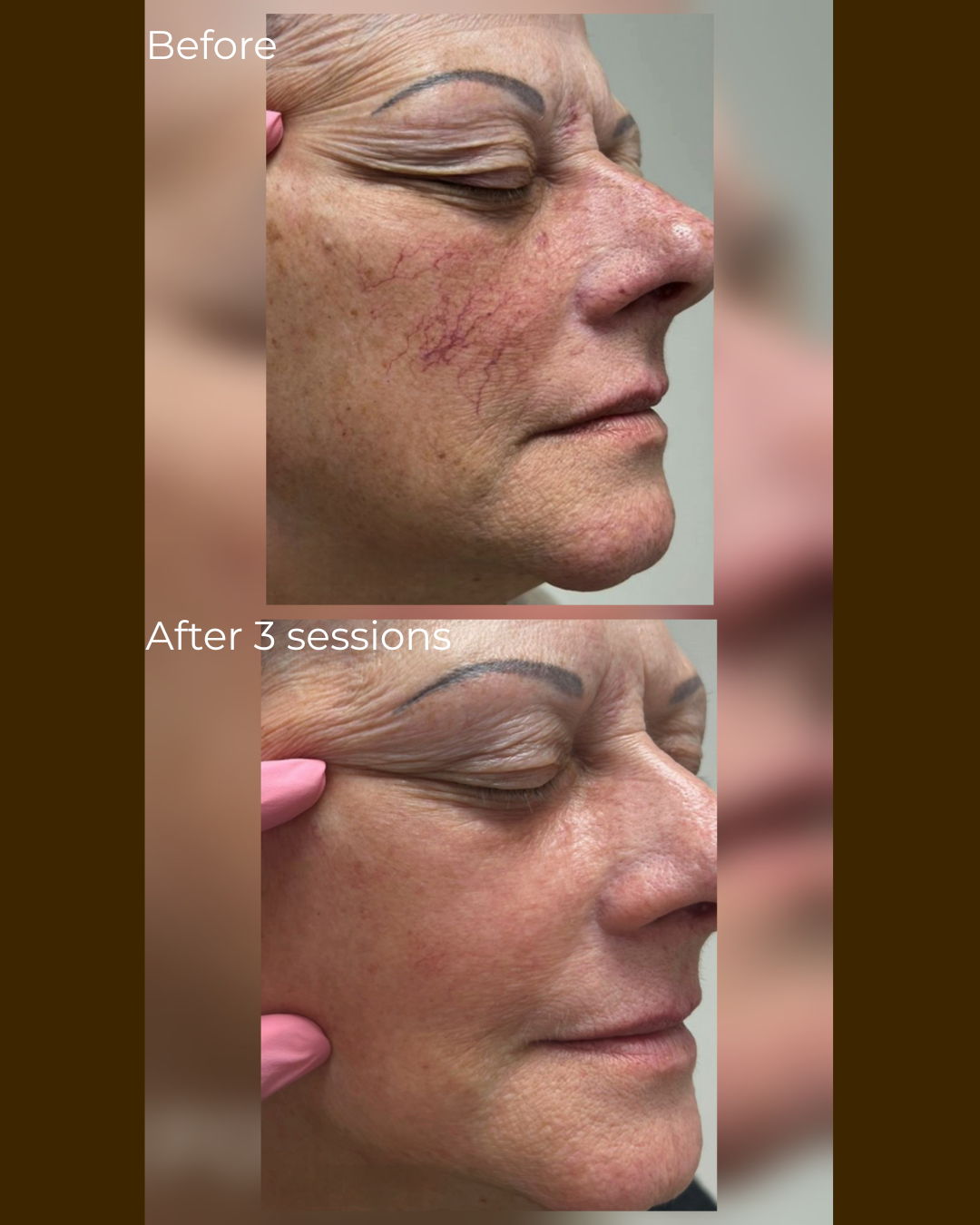Before and after firmness