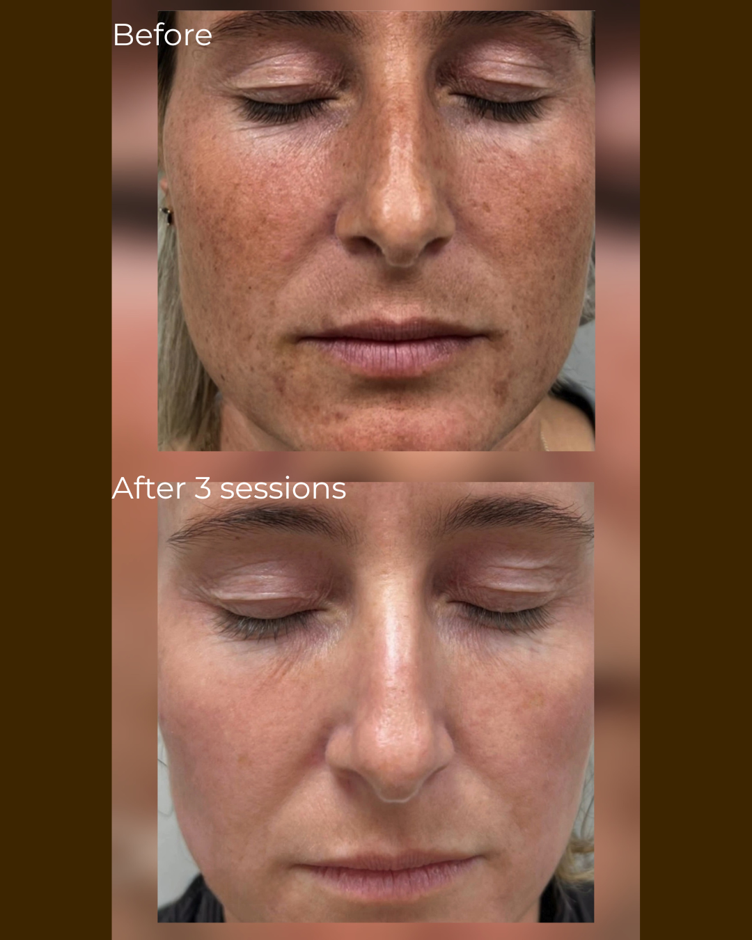 Before and after skin clarity