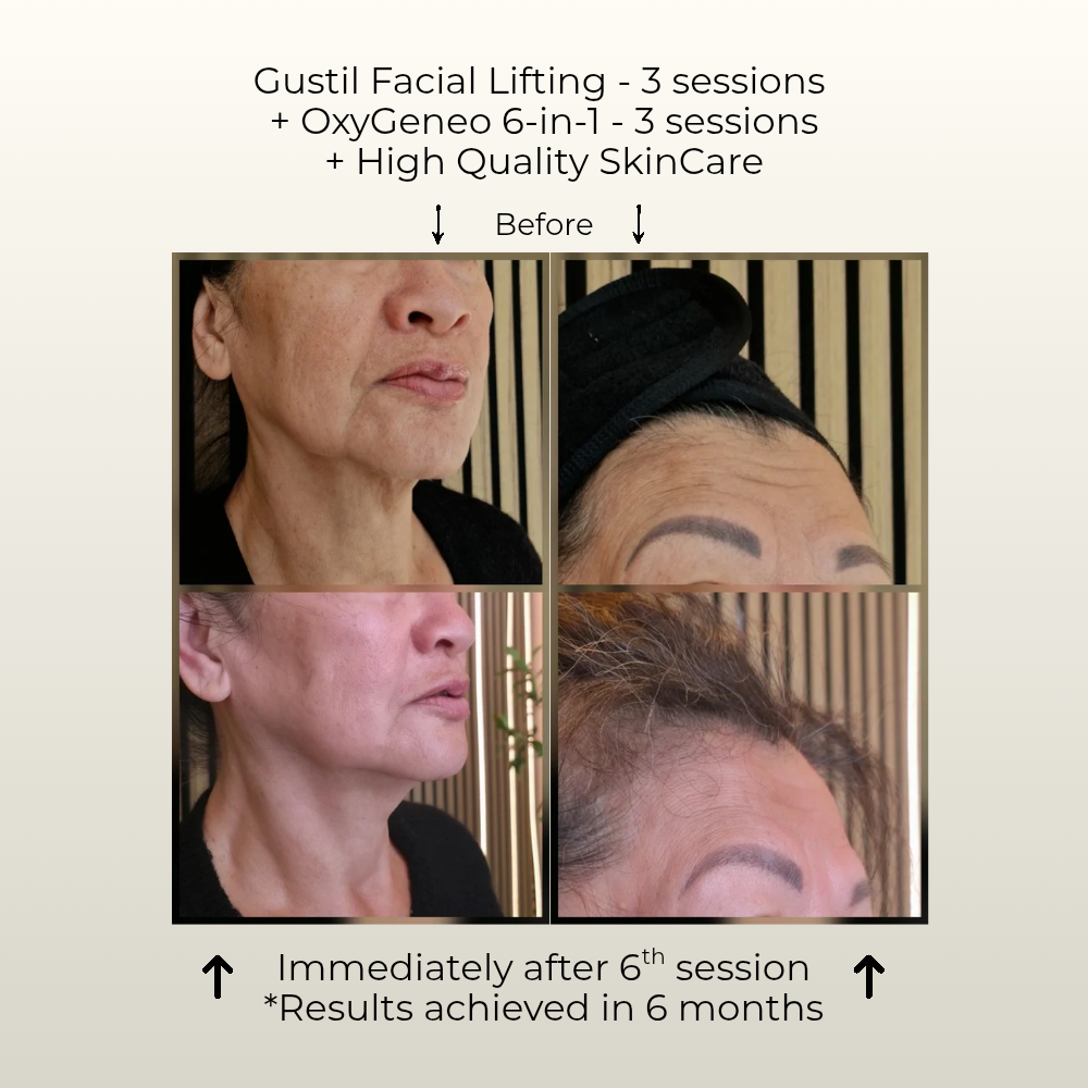 Skin Longevity before and after Gustil Aesthetics client 45 plus