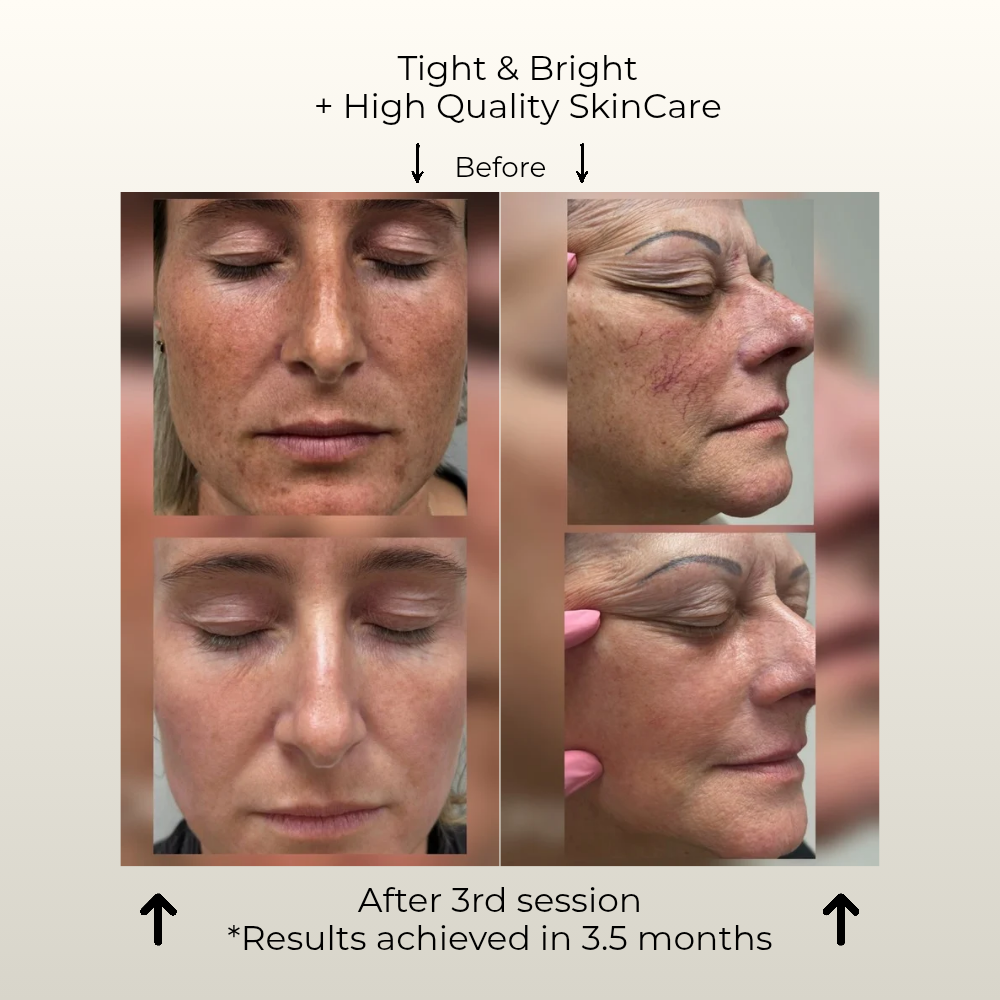 Skin Longevity before and after Gustil Aesthetics client 45 plus