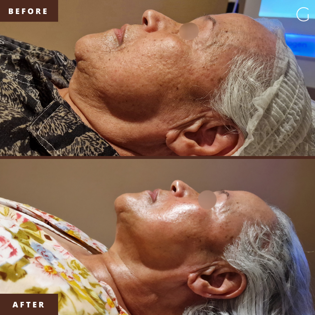 Sagging skin result after a premium skin treatment at the clinic