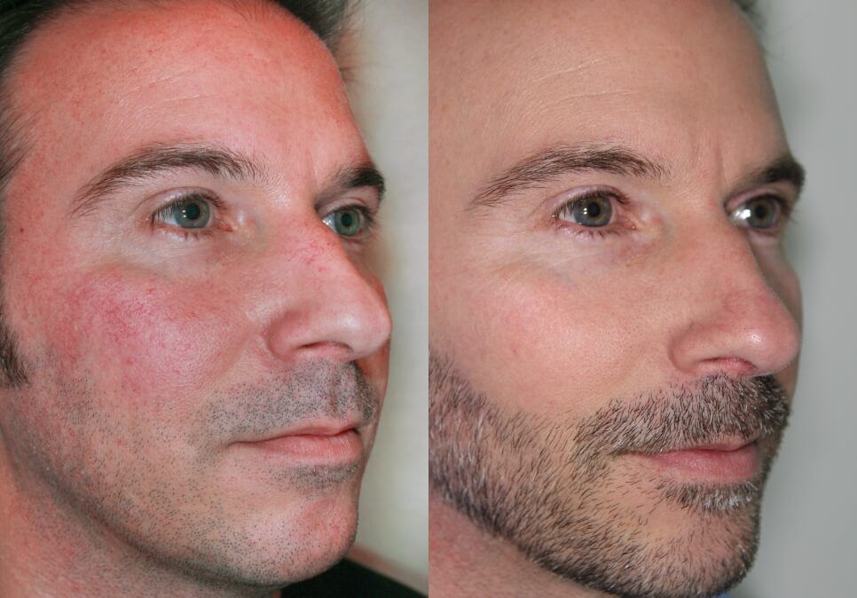 Before and after 3