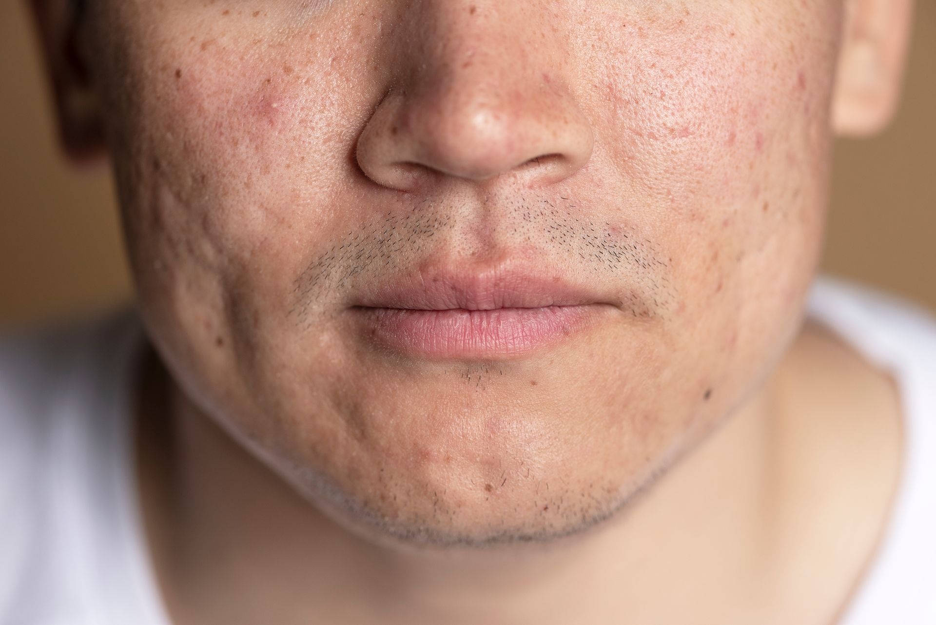 Consult over huidproblemen bij Gustil Aesthetics
