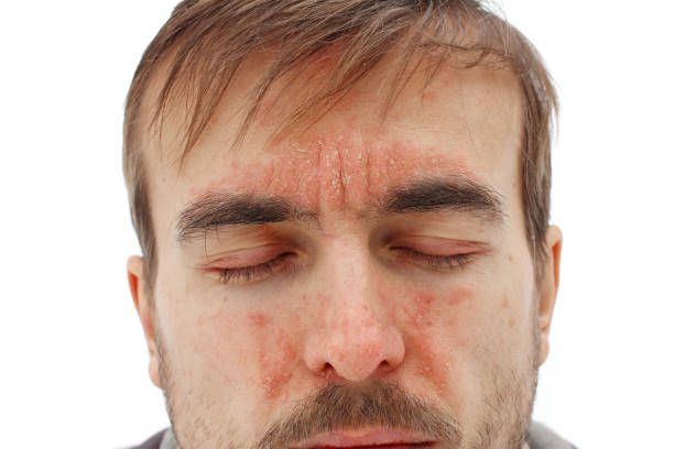 Soft visual for psoriaris