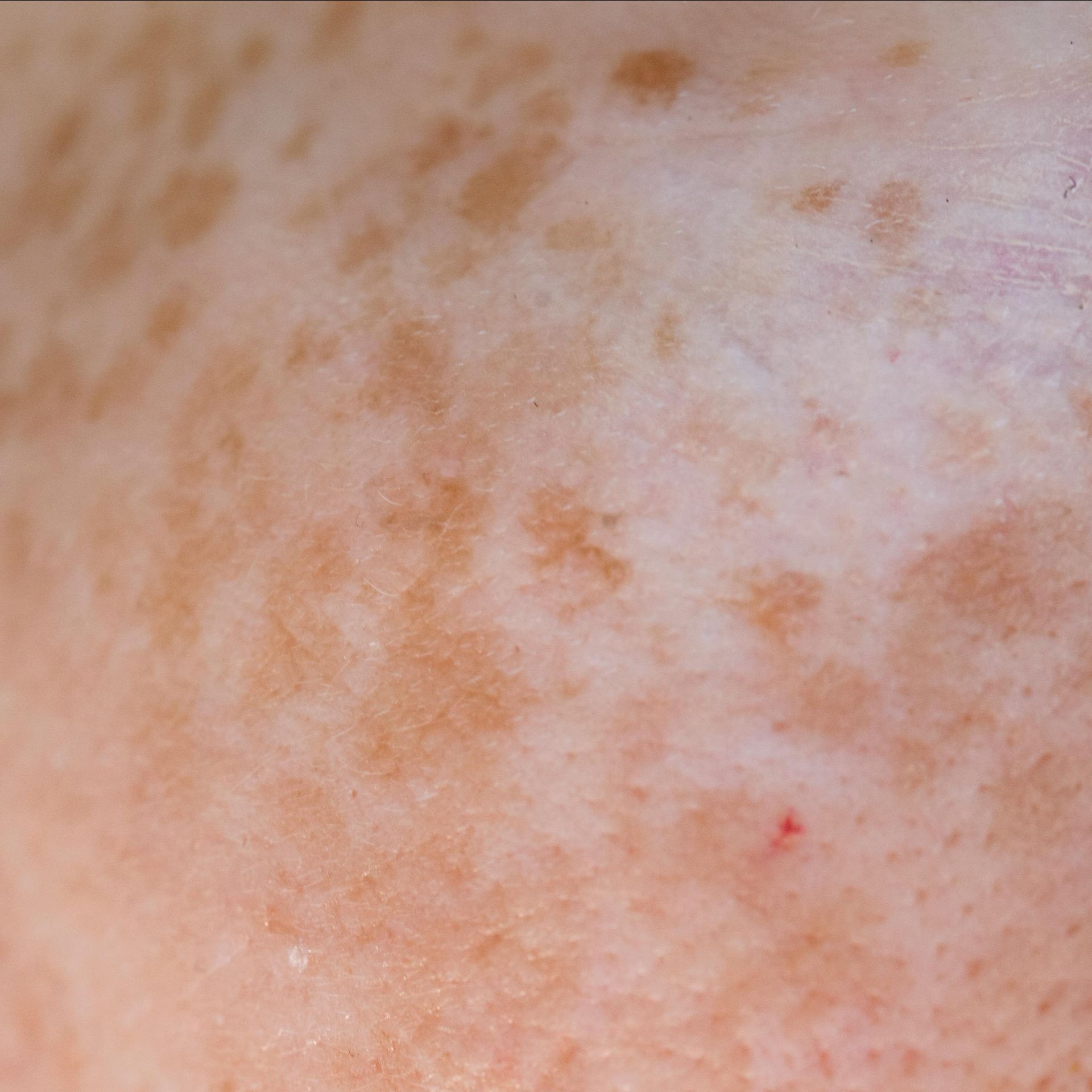 Pigmentation and dark spots