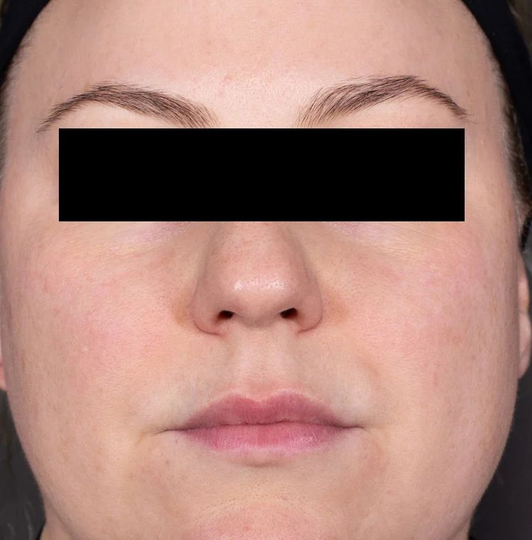After Retinol

