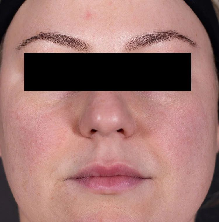 Before Retinol