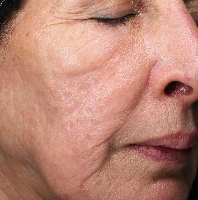 After Retinol