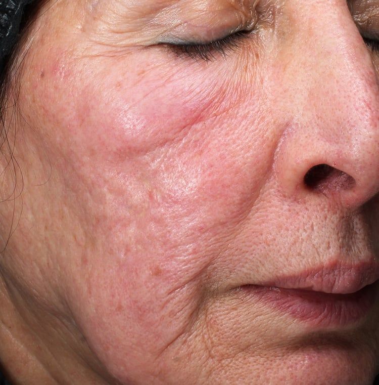 Before Retinol