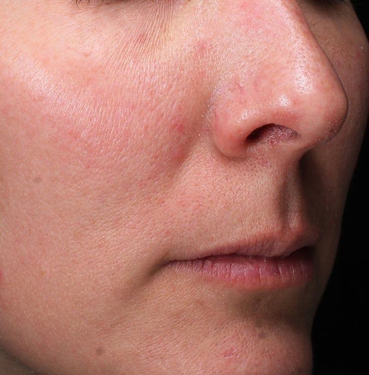 After Retinol