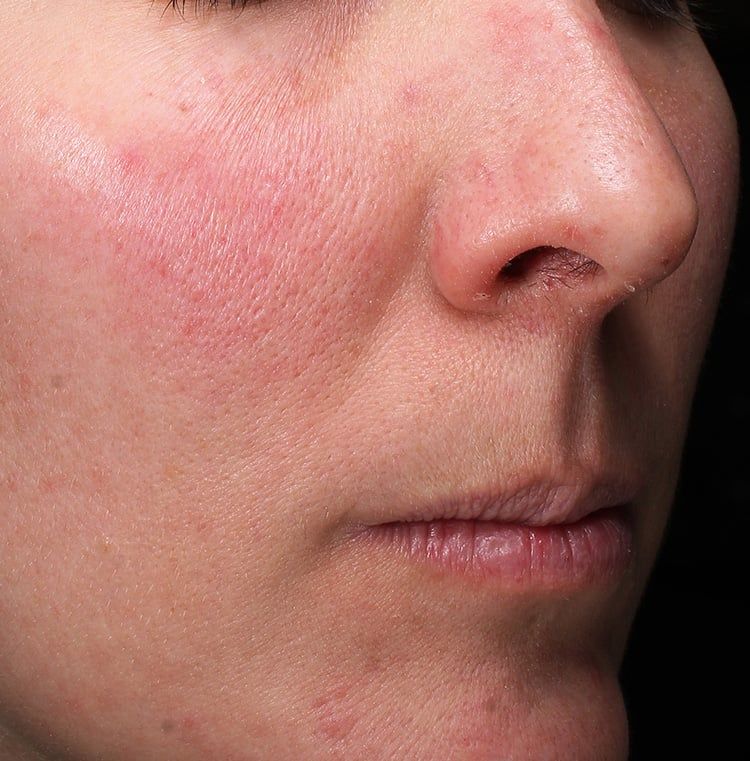 Before Retinol